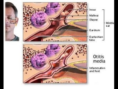 Otita medie